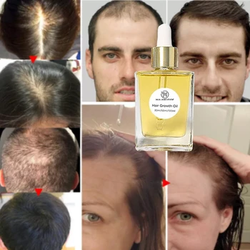 Saç büyüme uçucu yağ doğal anti-saç dökülmesi hızlı büyüme saç dökülmesini önlemek için saç bakım ürünleri erkekler ve kadınlar için